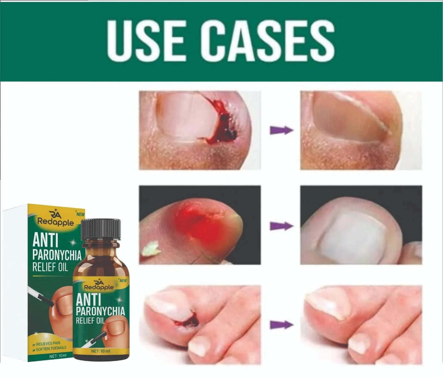 Anti Paronychia Relief Oil- Buy 1 Get 1 Free!!!