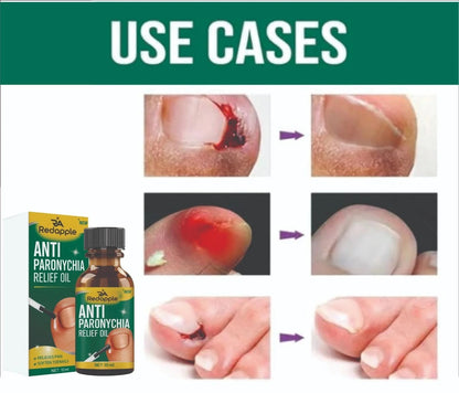 Anti Paronychia Relief Oil- Buy 1 Get 1 Free!!!
