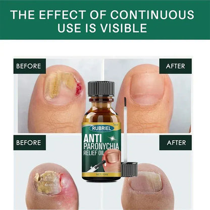 Anti Paronychia Relief Oil- Buy 1 Get 1 Free!!!